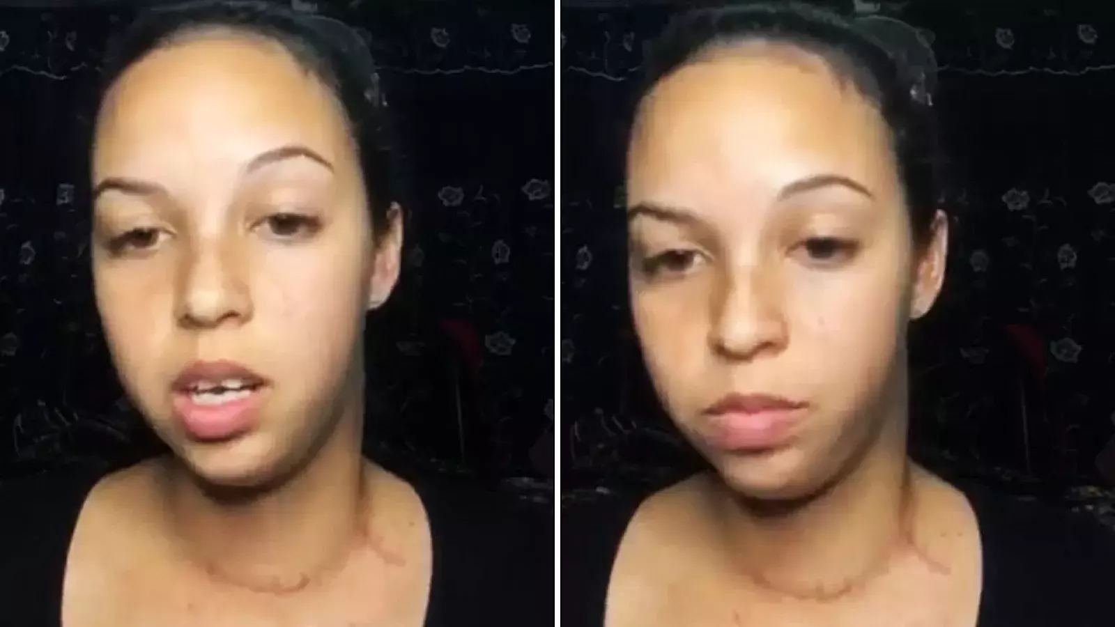 La cubana fue diagnosticada el año anterior con un carcinoma papilar de tiroides, con metástasis hasta los ganglios