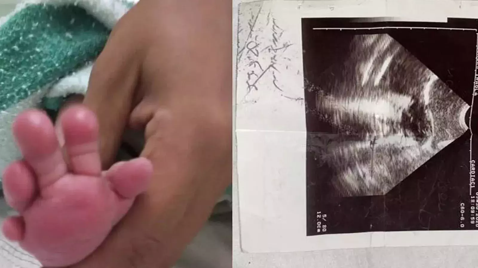 Madre cubana desesperada pide ayuda para su hija de 2 años con rara enfermedad