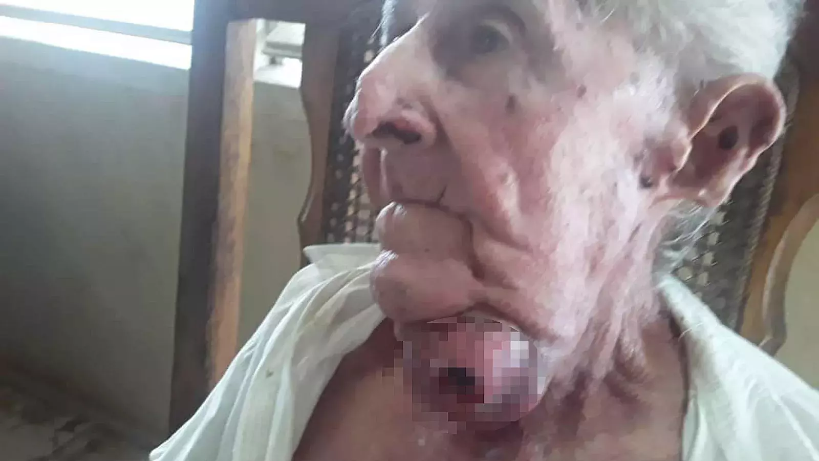 Anciano con bulto en su barbilla y no hay maxilofacial para operarlo en Villa Clara