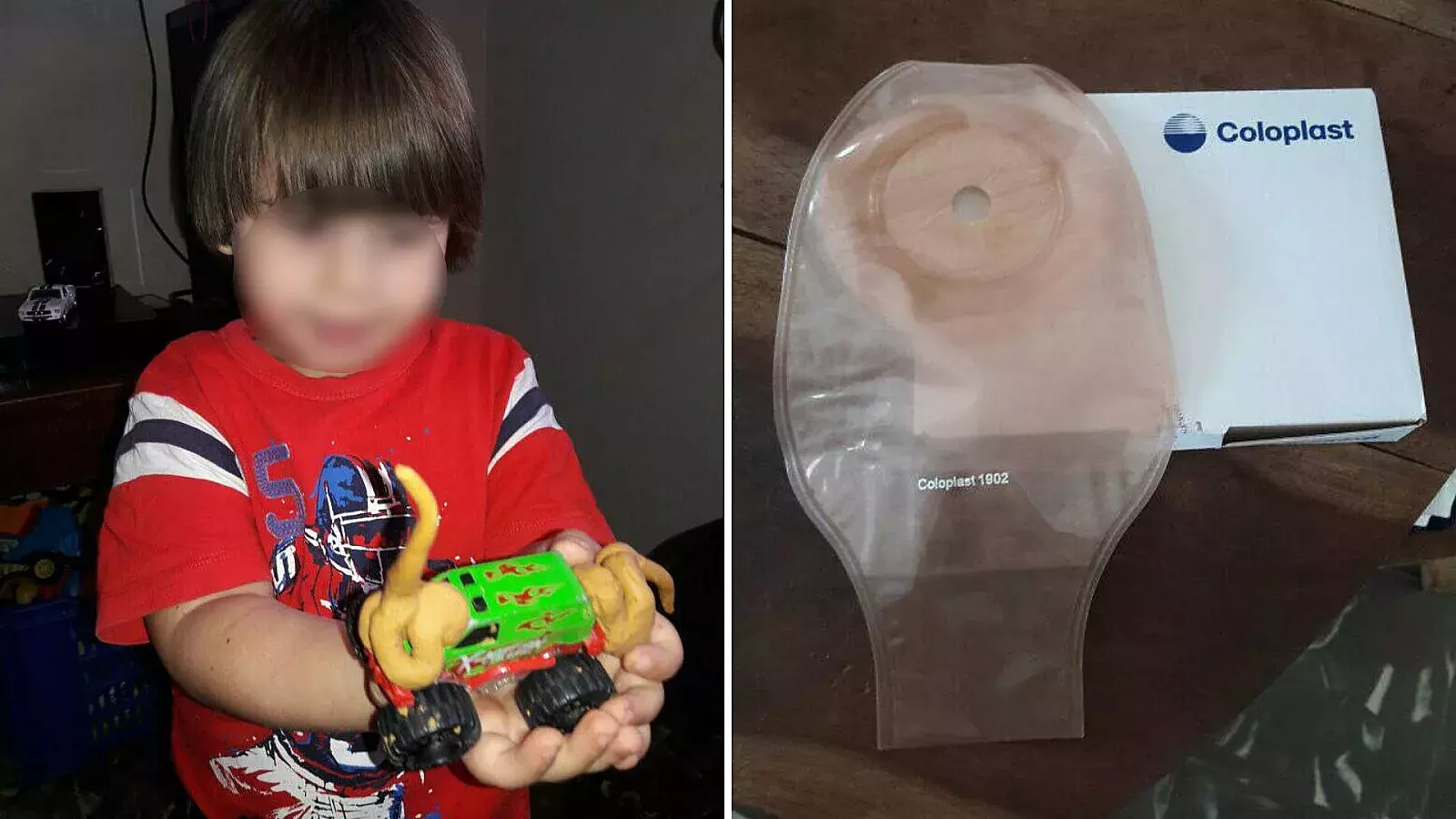 Niño cubano necesita bolsas de colostomía