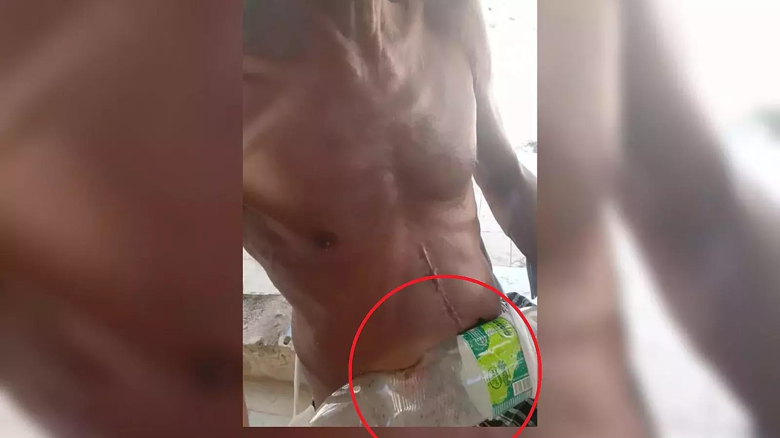 Anciano cubano sin bolsas de colostomía