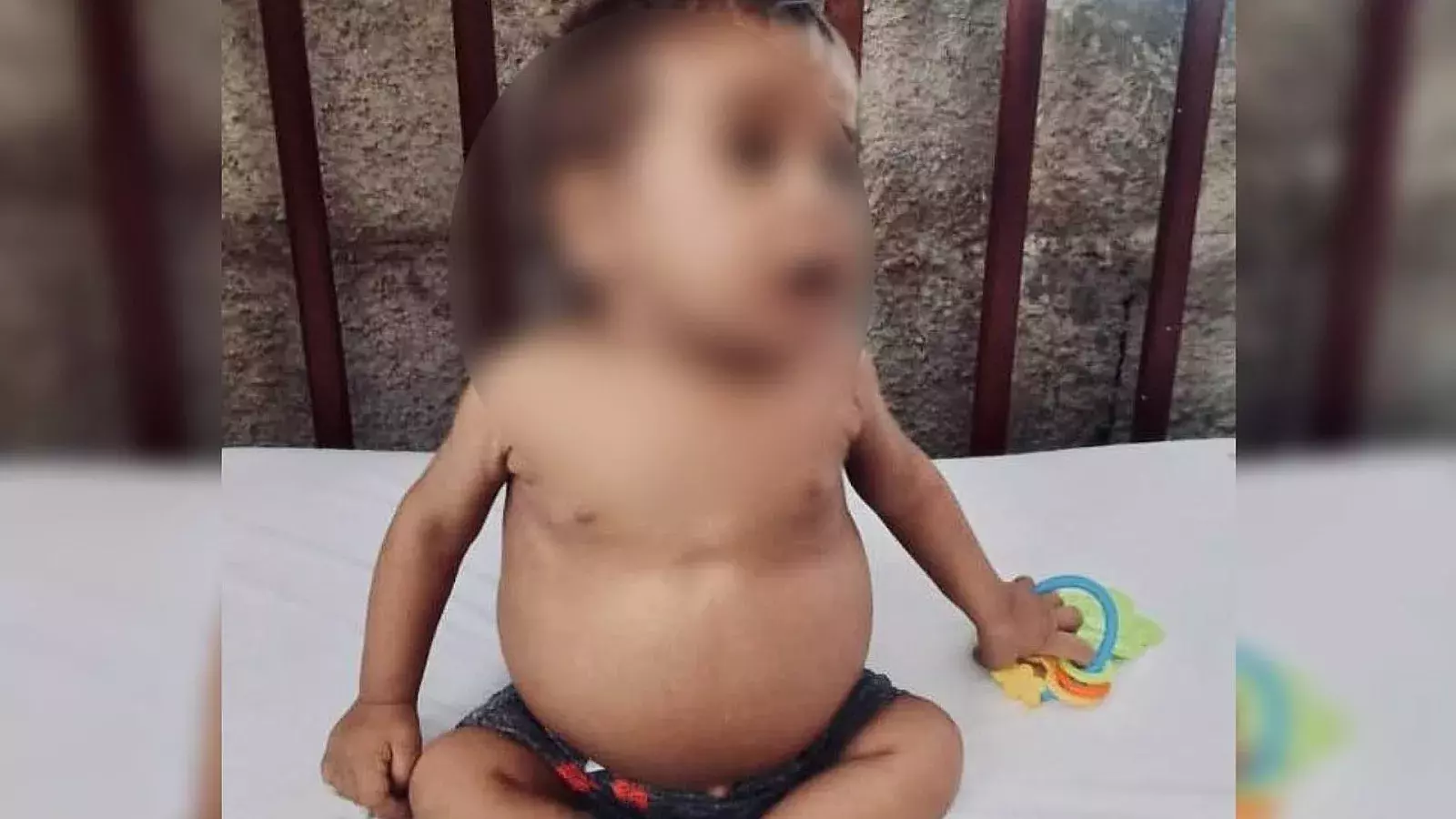 Bebé cubano que necesita trasplante de hígado
