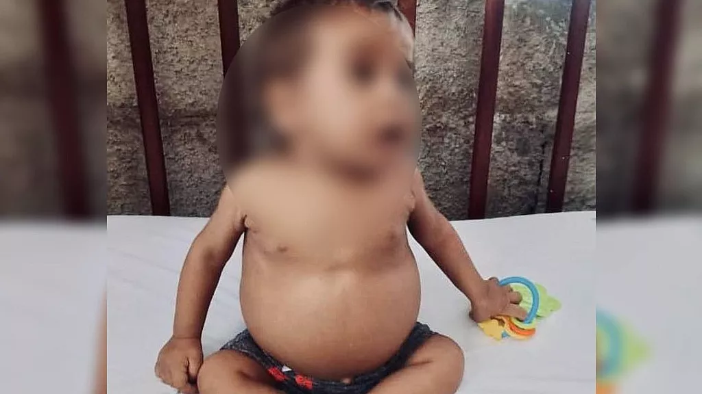Bebé cubano que necesita trasplante de hígado